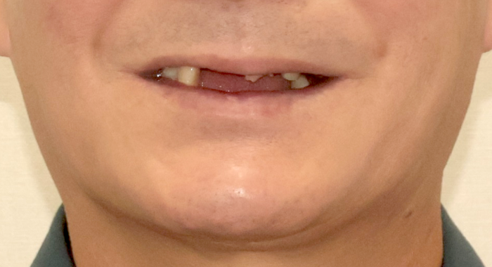 Before